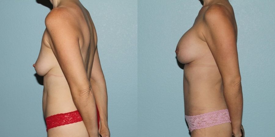 Breast Augmentation - Thumbnail 3