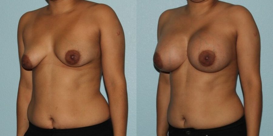 Breast Augmentation - Thumbnail 2