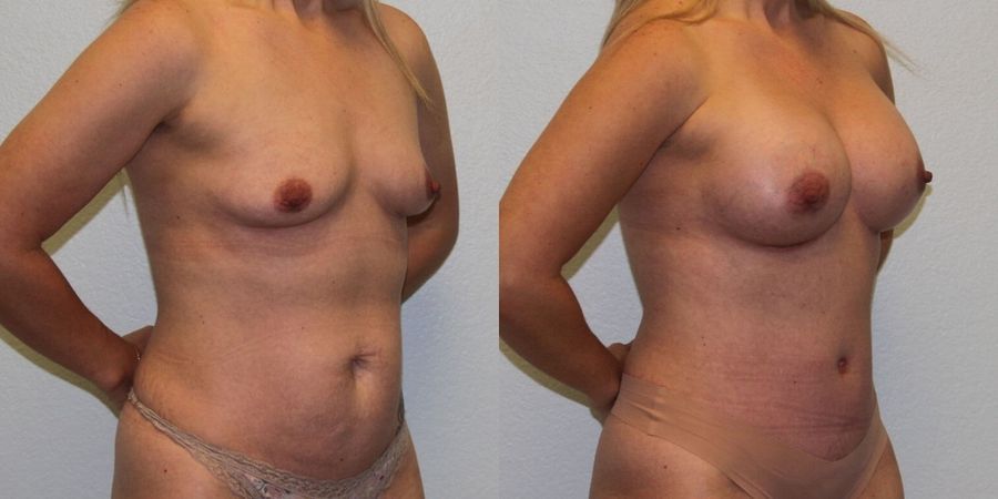 Breast Augmentation - Thumbnail 2