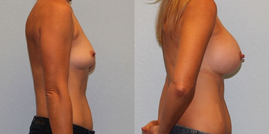 Breast Augmentation - Thumbnail 3