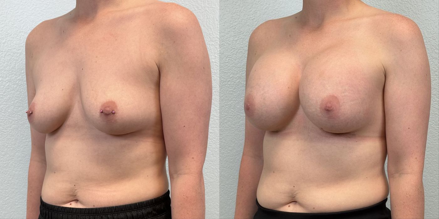 Breast Augmentation - Thumbnail 3