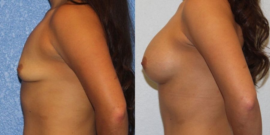 Breast Augmentation - Thumbnail 3