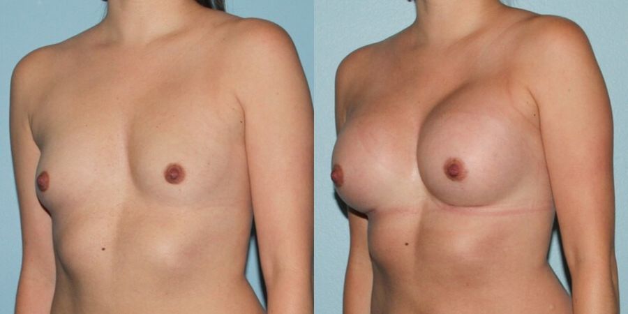 Breast Augmentation - Thumbnail 2