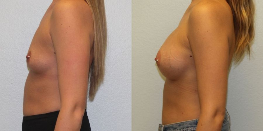 Breast Augmentation - Thumbnail 3