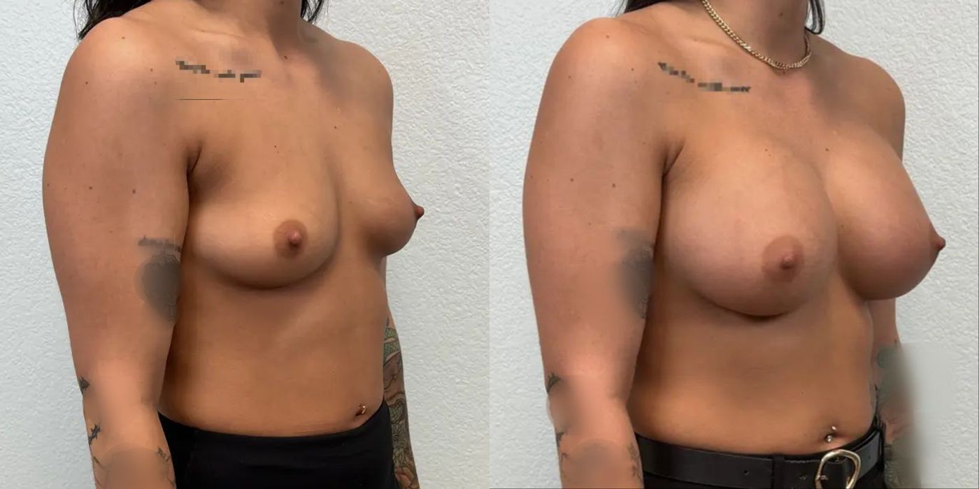 Breast Augmentation - Thumbnail 2