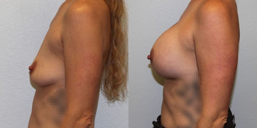 Breast Augmentation - Thumbnail 3