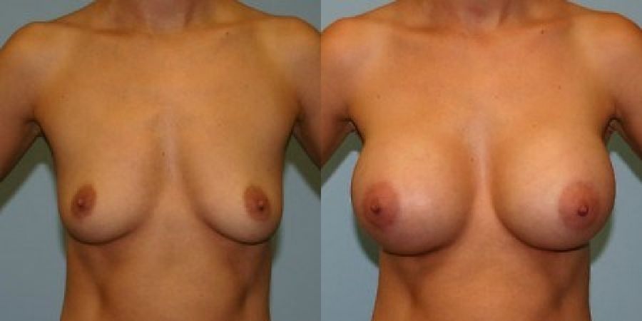 Breast Augmentation - Case 19290