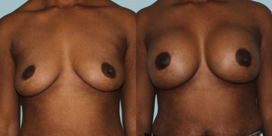 Breast Augmentation - Case 19341