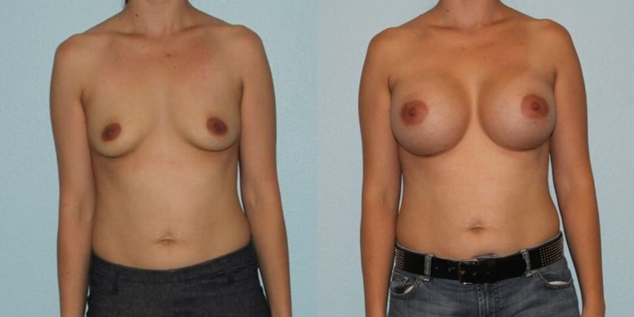 Breast Augmentation - Case 19337