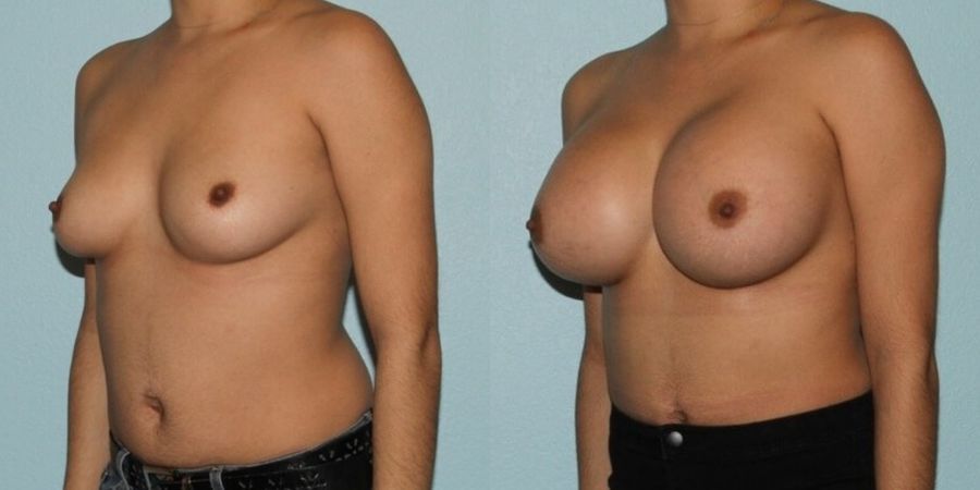 Breast Augmentation - Thumbnail 2