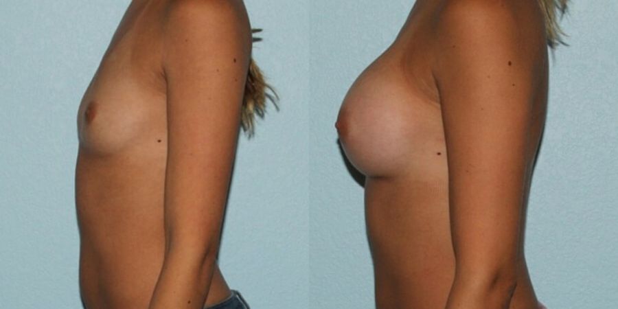 Breast Augmentation - Thumbnail 3
