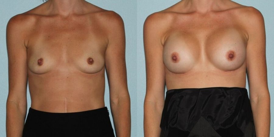 Breast Augmentation - Case 19300