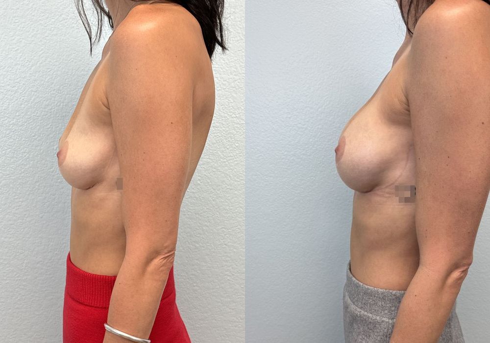 Breast Augmentation - Thumbnail 3