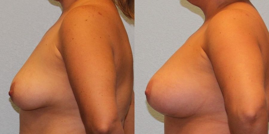 Breast Augmentation - Thumbnail 3