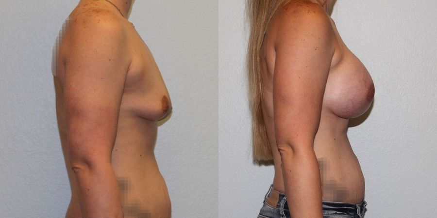 Breast Augmentation - Thumbnail 3