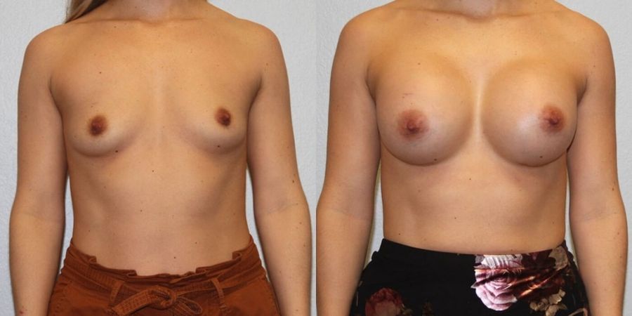 Breast Augmentation - Case 19329