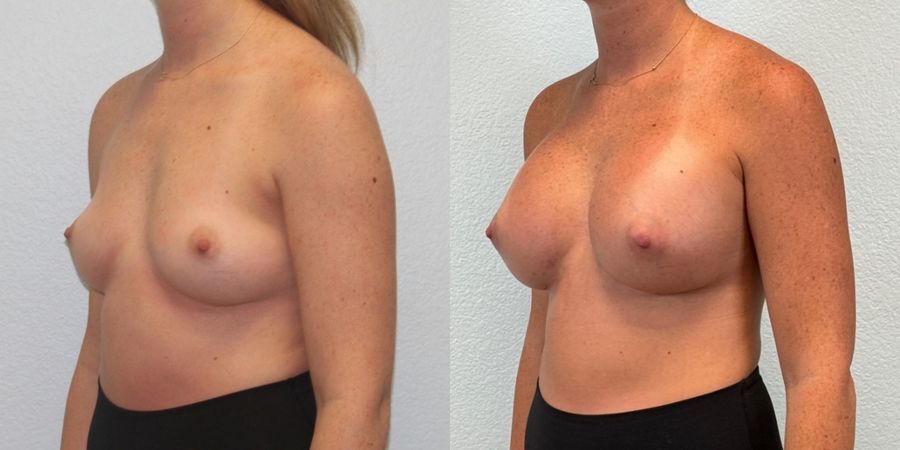 Breast Augmentation - Thumbnail 2