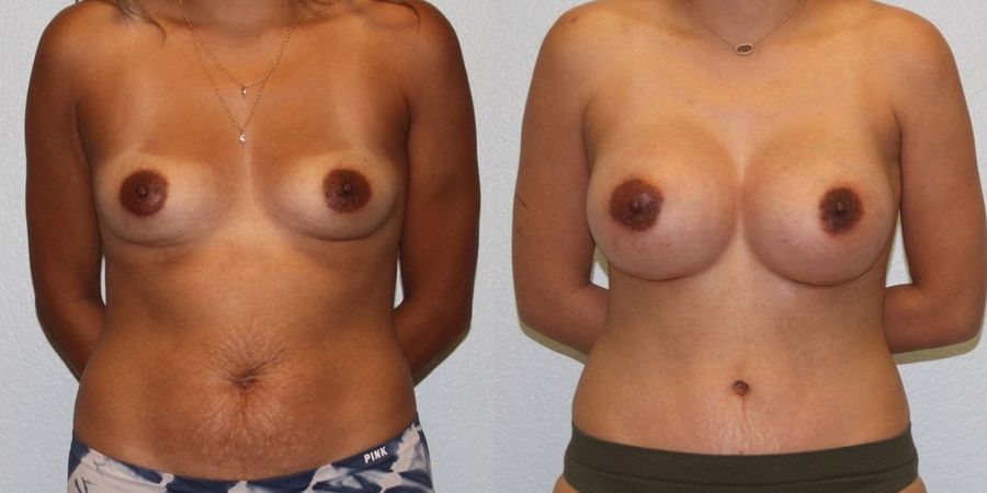 Breast Augmentation - Case 19269