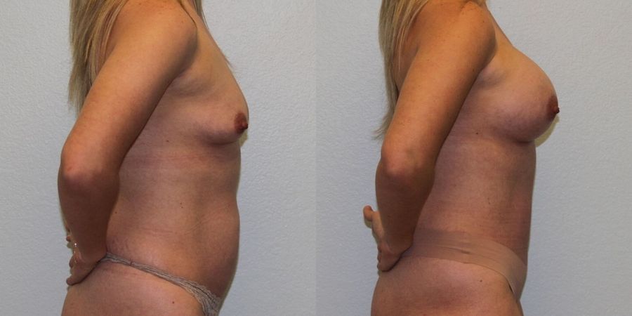 Breast Augmentation - Thumbnail 3