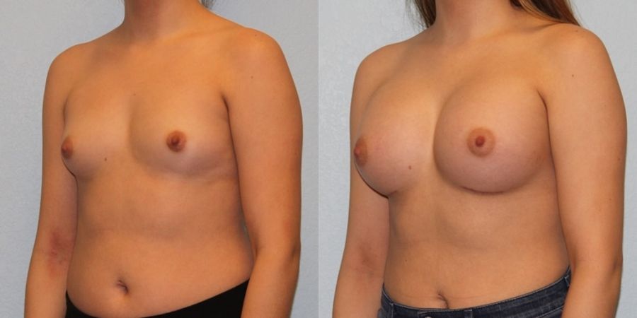Breast Augmentation - Thumbnail 2