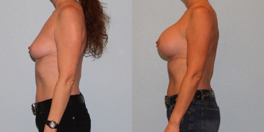Breast Augmentation - Thumbnail 3