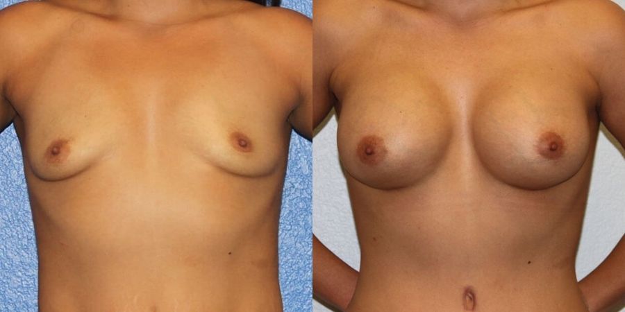 Breast Augmentation - Case 19282