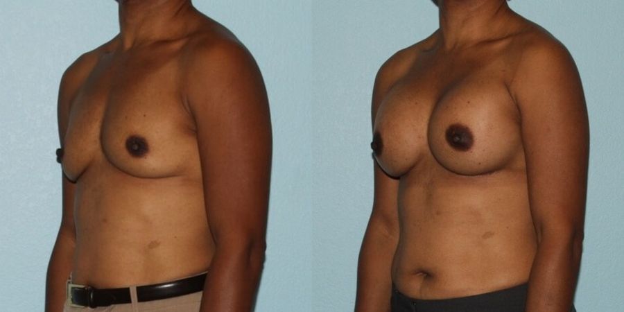 Breast Augmentation - Thumbnail 2