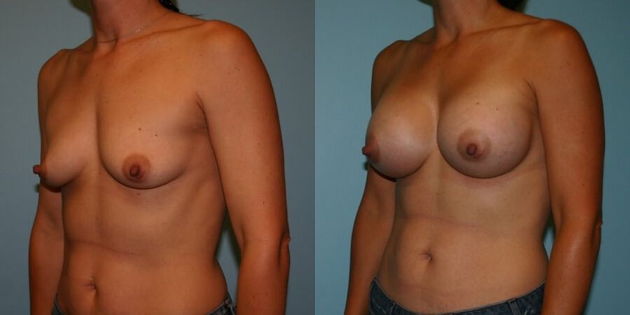 Breast Augmentation - Thumbnail 2