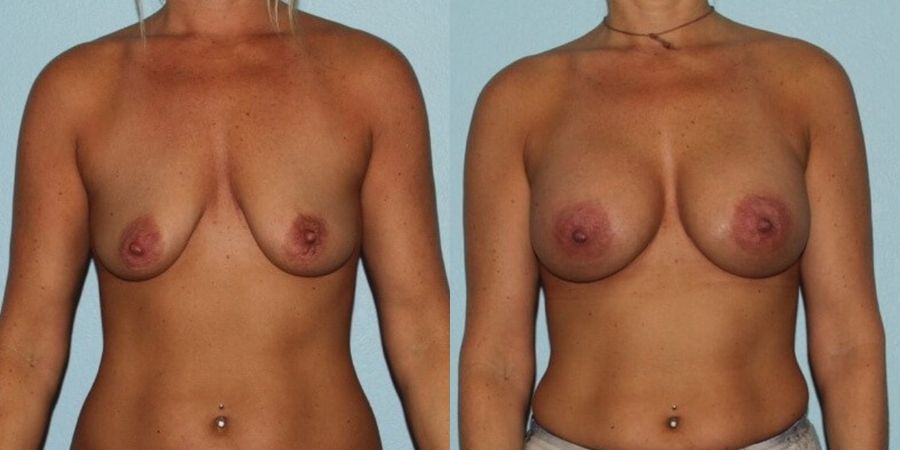 Breast Augmentation - Case 19304