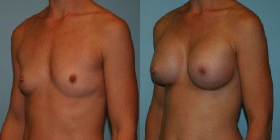 Breast Augmentation - Thumbnail 2