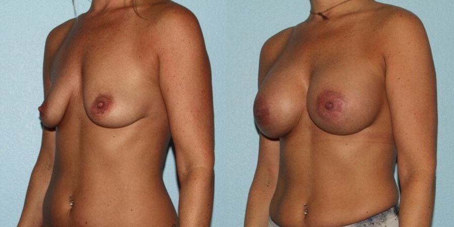 Breast Augmentation - Thumbnail 2