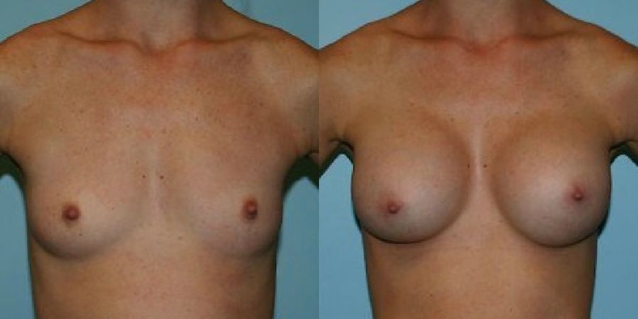 Breast Augmentation - Case 19289
