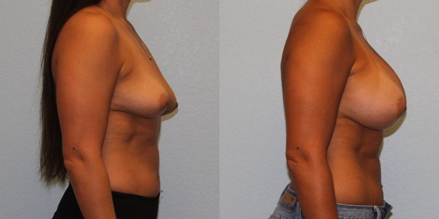 Breast Augmentation - Thumbnail 3