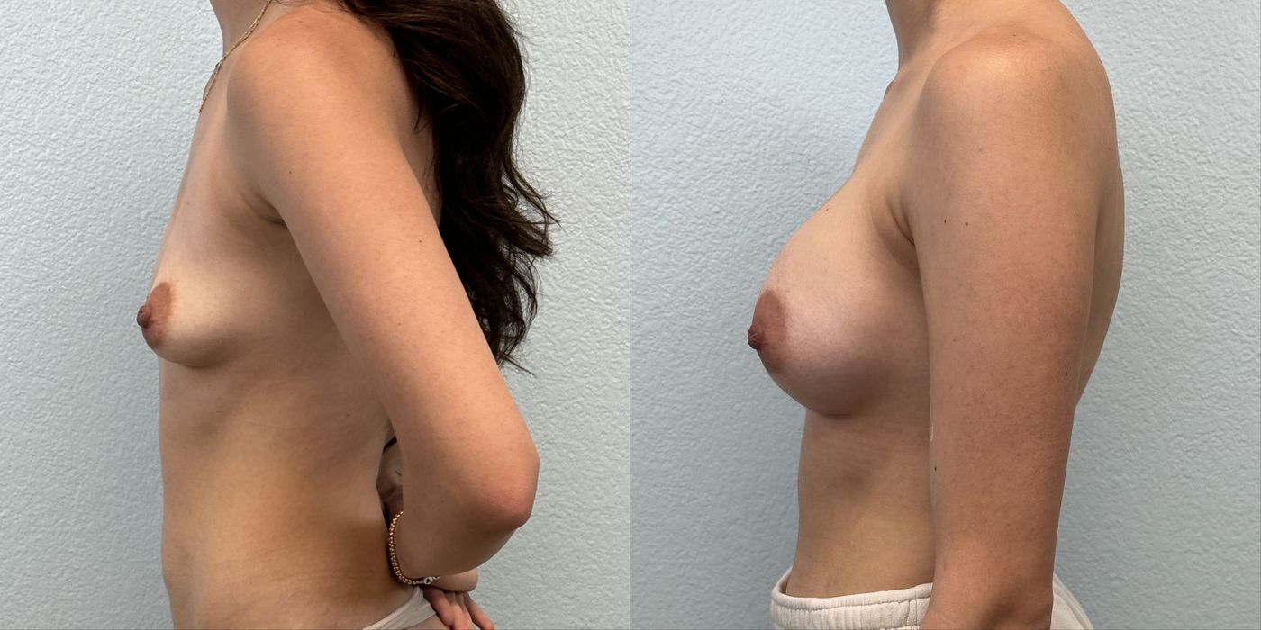 Breast Augmentation - Thumbnail 3