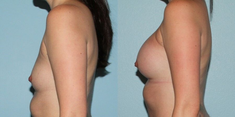 Breast Augmentation - Thumbnail 3