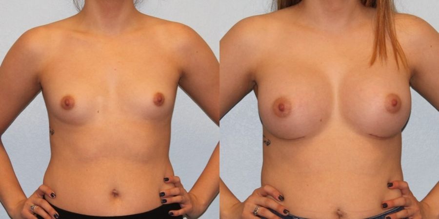 Breast Augmentation - Case 19331