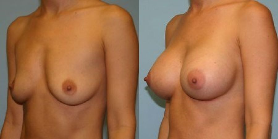 Breast Augmentation - Thumbnail 2