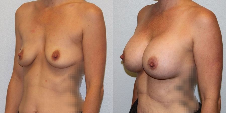 Breast Augmentation - Thumbnail 2