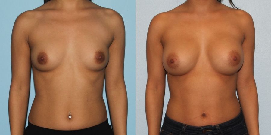 Breast Augmentation - Case 19326