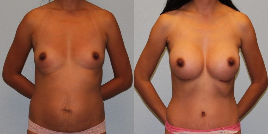 Breast Augmentation - Case 19274