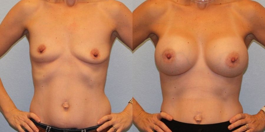 Breast Augmentation - Case 19344