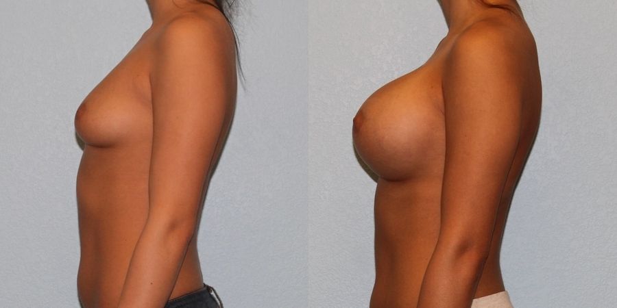 Breast Augmentation - Thumbnail 3