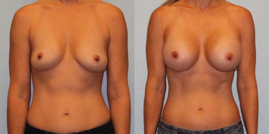 Breast Augmentation - Case 19314