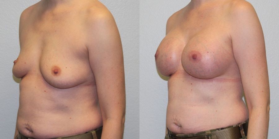 Breast Augmentation - Thumbnail 2