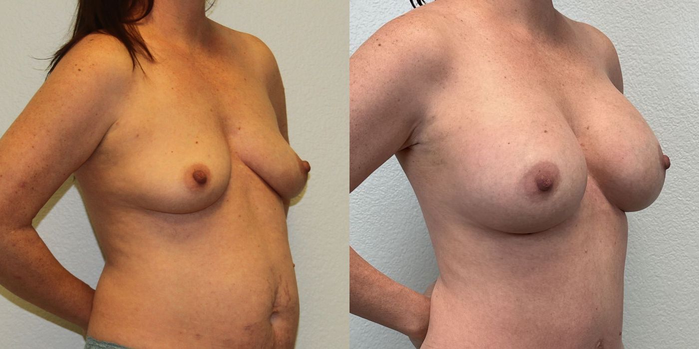 Breast Augmentation - Thumbnail 2