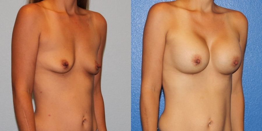 Breast Augmentation - Thumbnail 2