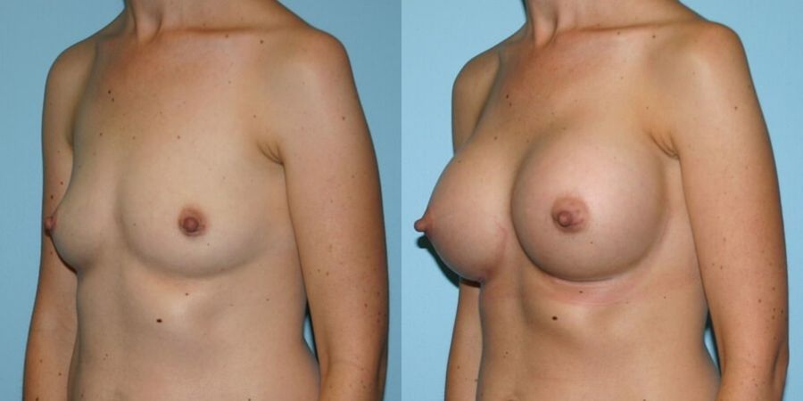 Breast Augmentation - Thumbnail 2