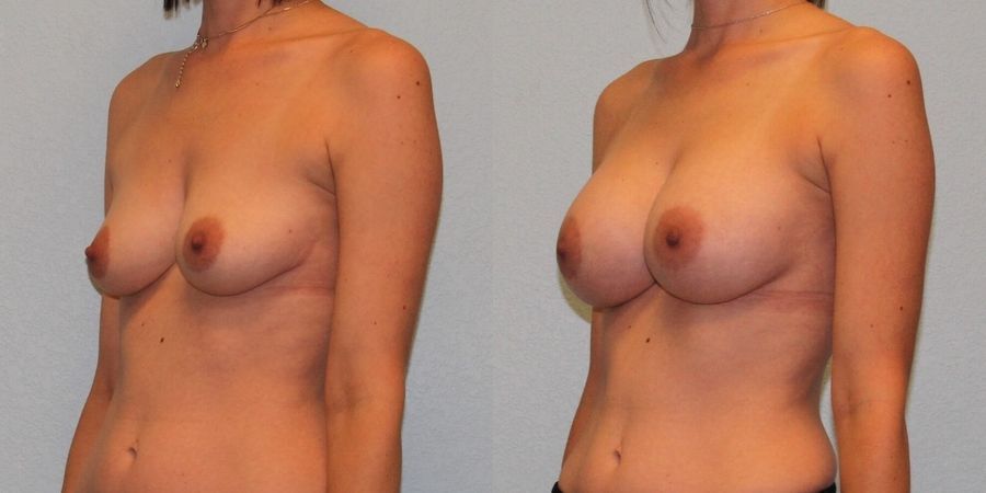 Breast Augmentation - Thumbnail 2