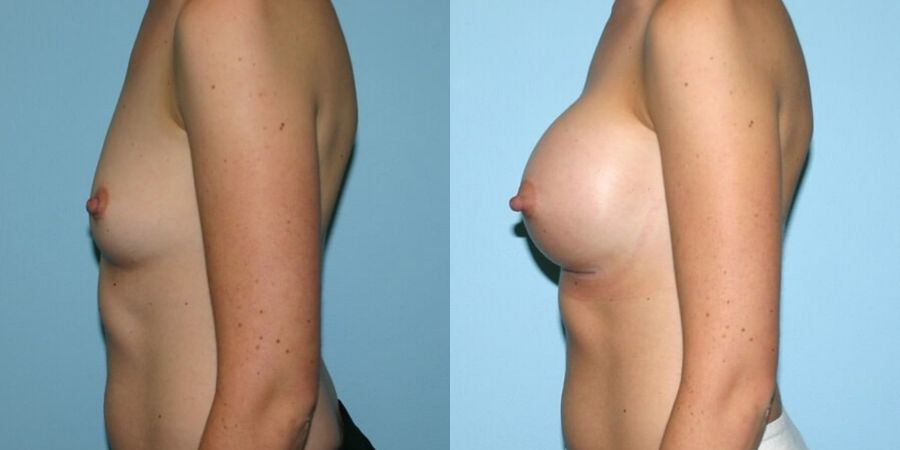 Breast Augmentation - Thumbnail 3