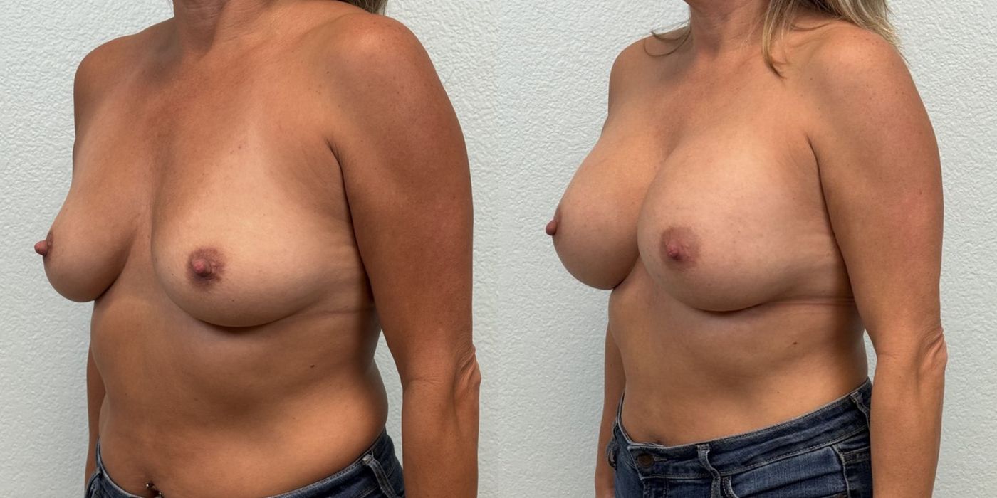 Breast Augmentation - Thumbnail 2